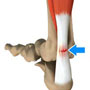  Achilles Tendon Tear Repair