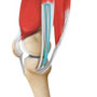 ACL Reconstruction Hamstring Method