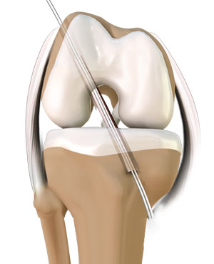 Knee Image ACL Reconstruction