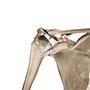 Acromioclavicular Joint (AC joint) Dislocation