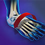 Ankle Instability Surgery