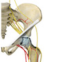 Core Decompression for Avascular Necrosis of the Hip