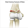 Distal Humerus Fractures of the Elbow  