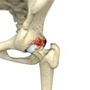 Femoroacetabular Impingement