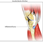 Goosefoot Bursitis of the Knee