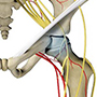 Hip Avascular Necrosis