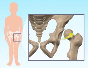 Developmental Dysplasia