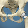 Hip Hemiarthroplasty