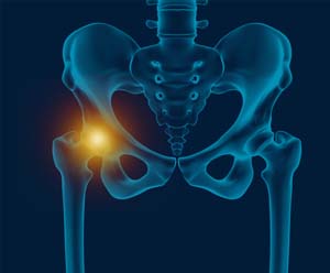 Core Decompression for Avascular Necrosis of the Hip