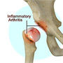 Inflammatory Arthritis of the Hip