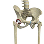 Revision Hip Replacement