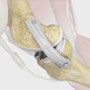 Medial Collateral Ligament Reconstruction