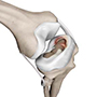 Meniscal Injuries