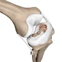 Knee Image Meniscal Tears