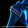 Open reduction and Internal Fixation of Proximal Humerus Fracture