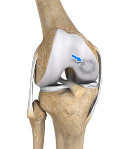 Osteochondritis Dissecans Elbow