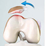 Patellar Dislocation/Patellofemoral Dislocation