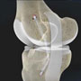 Posterior Cruciate Ligament Reconstruction