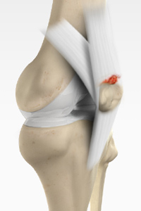 Quadriceps Tendon Rupture