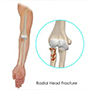 Radial Head Fractures of the Elbow 