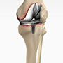 Revision Knee Replacement