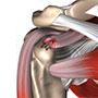 Rotator Cuff Repair