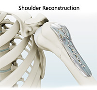 Shoulder Labrum Reconstruction