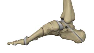 Subtalar Arthrodesis