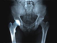 Transient Osteoporosis of the Hip