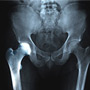 Transient Osteoporosis of the Hip