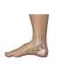 Achilles Tendon Bursitis