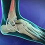 Ankle Ligament Reconstruction