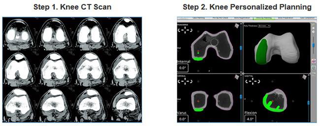 MAKO Robotic Partial Knee Replacement