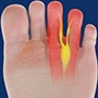 Morton's neuroma