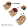 nail-bed-injuries-th