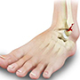 Stress Fractures of the Foot and Ankle