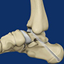 Subtalar Arthrodesis